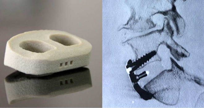 L’implant imprimé en 3D mis au point par Medicrea