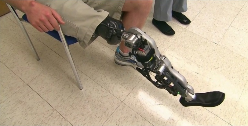 prothèse bionic